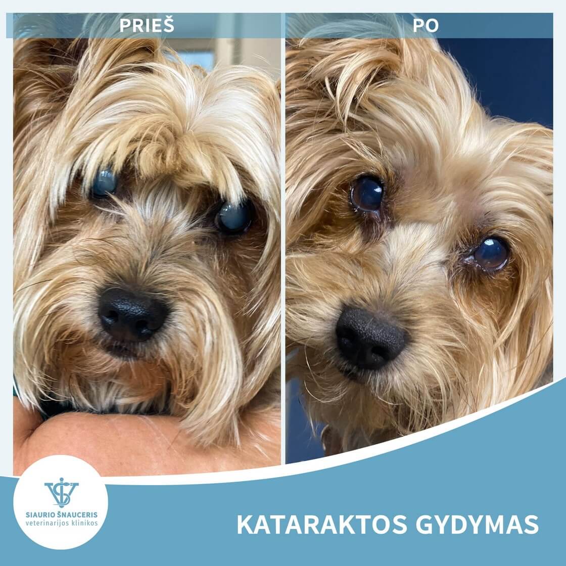 Gučio istorija – Kataraktos gydymas
